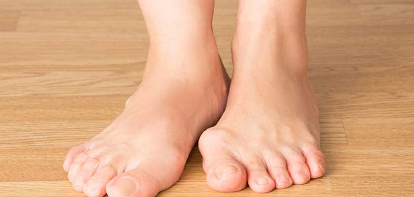 Bunion removal foot surgery